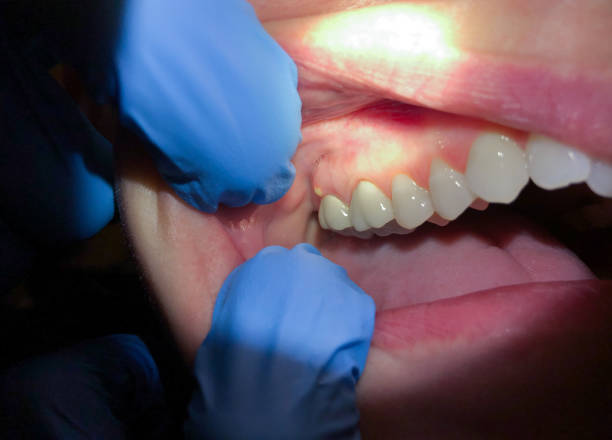 Best Emergency Dental Care for Broken or Chipped Teeth in Morrisonvle, IL